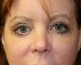 Eyelid-Lift-San-Diego-64 - after