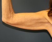 Arm-Lift-San-Diego-7 - before