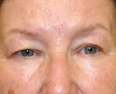Blepharoplasty Case 6 - before