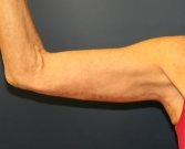 Arm-Lift-San-Diego-7 - after