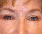 Blepharoplasty Case 6 - after