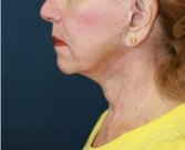 Neck Lift San Diego 21 - before