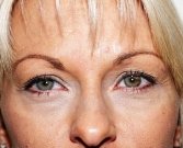 Blepharoplasty Case 7 - before