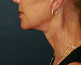 NeckLift San Diego 22 - after