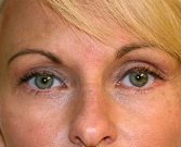 Blepharoplasty Case 7 - after