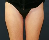 Liposuction Outer Thighs - before