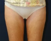 Liposuction Outer Thighs - after