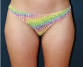 Liposuction Inner and Outer Thighs - after