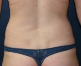 Liposuction Flanks - before