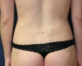 Liposuction Flanks - after