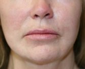 Lip Lift San Diego - before