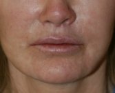 Lip Lift San Diego - after