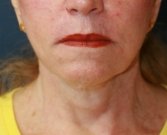 Lip Lift San Diego 26 - before