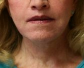 Lip Lift San Diego 26 - after