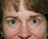 Blepharoplasty Case 8 - before