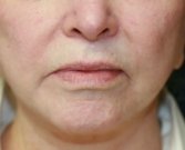 Lip Lift-San-Diego-27 - before