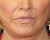Lip Lift-San-Diego-27 - after
