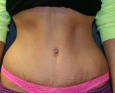 Tummy Tuck San Diego 50 - after