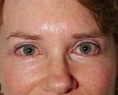 Blepharoplasty Case 8 - after