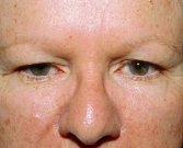 Blepharoplasty Case 9 - before