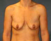 Breast Enhancement San Diego 85 - before