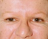Blepharoplasty Case 9 - after