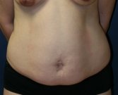 Tummy Tuck San Diego 51 - before