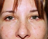 Blepharoplasty Case 10 - after