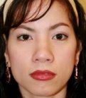 Rhinoplasty Case 3 - before