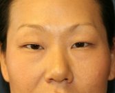 eyelid-surgery-san-diego-66 - before