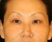 eyelid-surgery-san-diego-66 - after