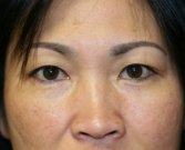 eyelid-surgery-san-diego-67 - before