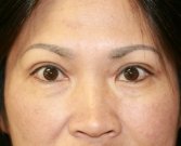 eyelid-surgery-san-diego-67 - after