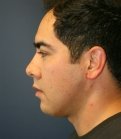 Facial Implants and Neck Plasty - after