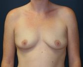 Breast Enlargement San Diego 93 - before