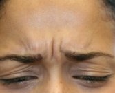 Botox between brows - before