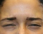 Botox between brows - after