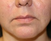 Lip Lift San Diego 28 - before