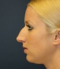 Nose Rhinoplasty 43 - before