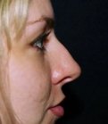 Rhinoplasty Case 6 - before