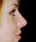 Rhinoplasty Case 6 - after