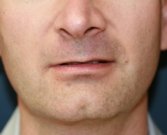 Lip Augmentation San Diego 30 - before