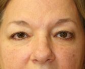 Eyelid Surgery San Diego Case 70 - before