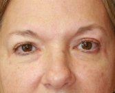Eyelid Surgery San Diego Case 70 - after