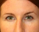 Eyelid Surgery San Diego Case 71 - after