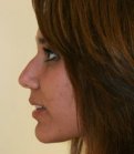 Rhinoplasty Case 7 - before