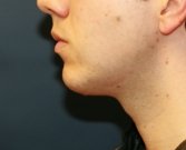 Chin Implant San Diego - after