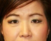 Double Eyelid Procedure (Upper & Lower) - before