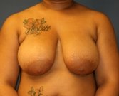 Breast Lift San Diego - before