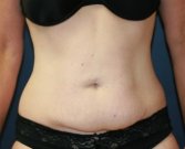Tummy Tuck San Diego 53 - before